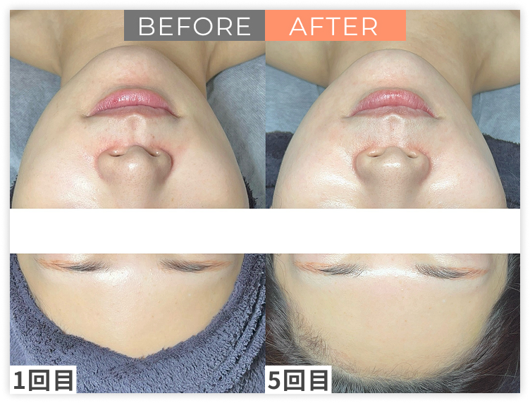 ララピール×LDMのビフォー/アフター